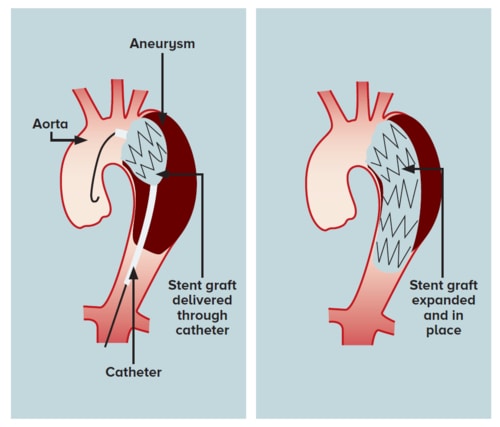 TEVAR procedure - SingHealth Duke-NUS Vascular Centre