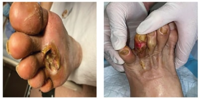 CLTI presenting as ulcers or absecesses - SingHealth Duke-NUS Vascular Centre