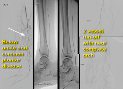 Distal percutaneous transluminal angioplasty and common plantar angioplasty - SingHealth Duke-NUS Vascular Centre