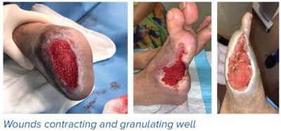 Wounds contracting and granulating well - SingHealth Duke-NUS Vascular Centre