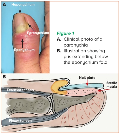 Paronychia - SGH