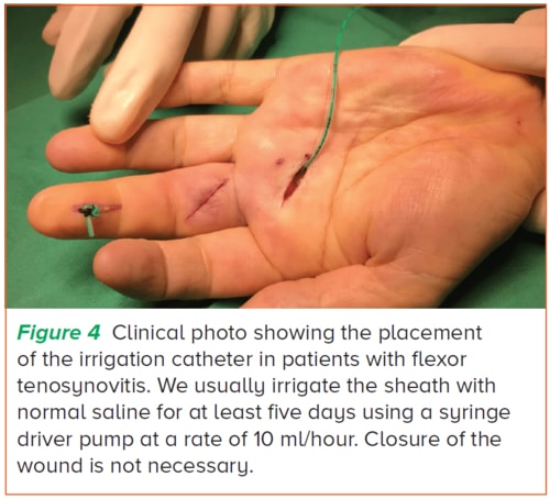 Closed tendon sheath irrigation for flexor tenosynovitis - SGH