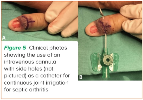 Catheter irrigation for septic arthritis - SGH