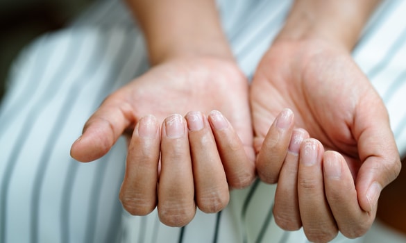 ​Common Infections of the Hand in Primary Care - SGH
