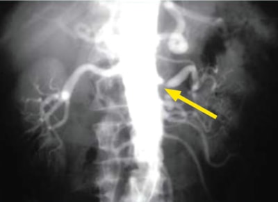 Arteriogram showing focal stenosis - SingHealth Duke-NUS Vascular Centre