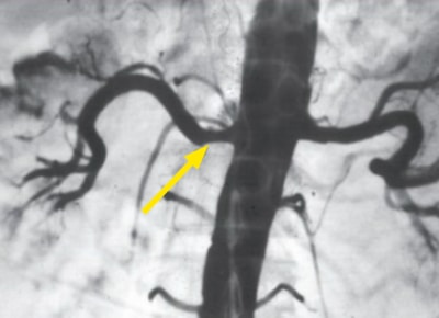 Arteriogram after percutaneous angioplasty - SingHealth Duke-NUS Vascular Centre