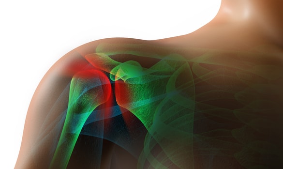 ​Common Shoulder Conditions and Their Management - SGH