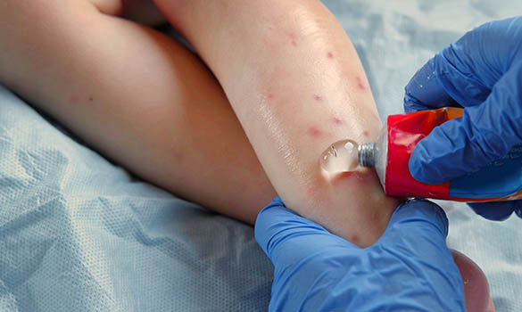 ​Envenomation, Bites and Stings: How to Manage in Primary Care - SGH