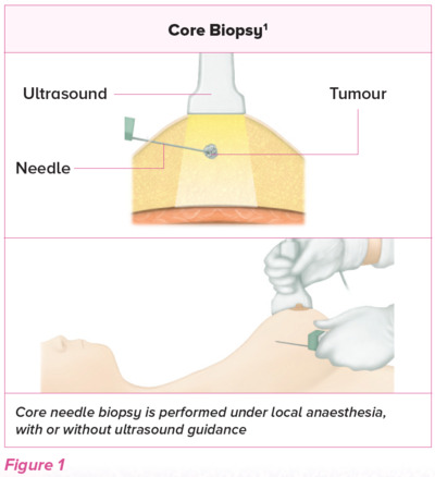 Core biopsy - SingHealth Duke-NUS Breast Centre