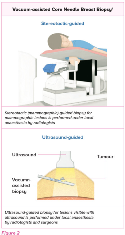 Vacuum-assisted core needle breast biopsy - SingHealth Duke-NUS Breast Centre