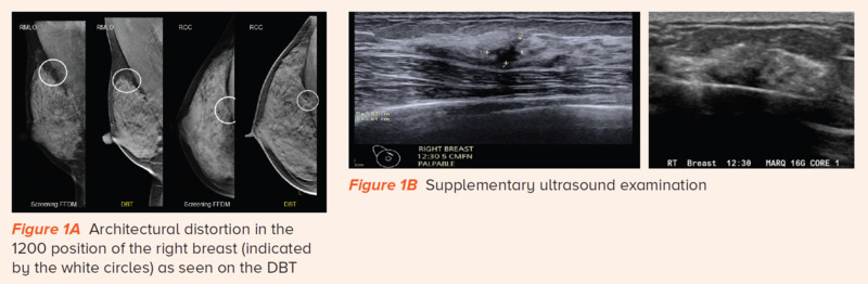 Digital breast tomosynthesis - SingHealth Duke-NUS Breast Centre