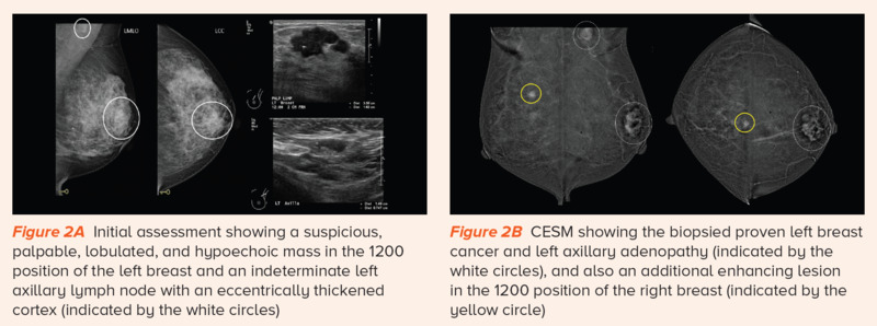 Contrast-enhanced spectral mammogram - SingHealth Duke-NUS Breast Centre