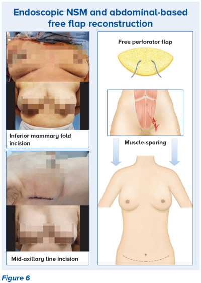 Endoscopic NSM and abnominal-based free flap reconstruction Volume Displacement and Volume Reduction oBCS Techniques - SingHealt