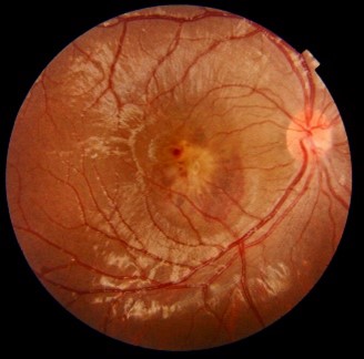 inherited retinal degeneration - SNEC