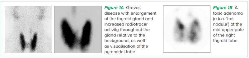 Thyrotoxicosis - SGH