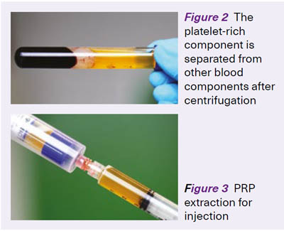 PRP treatment process - SingHealth Duke-NUS Sport & Exercise Medicine Centre