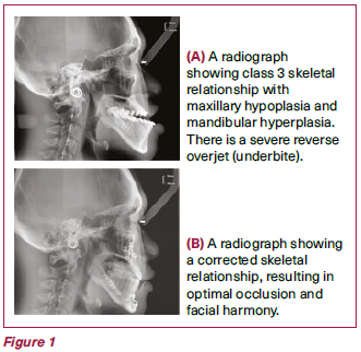 Corrected underbite with orthognatihic surgery - NDCS