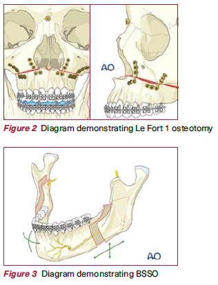 Le Fort 1 osteotomy and BSSO - NDCS