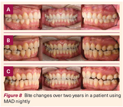 Bite changes in patient using MAD - NDCS