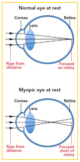 Normal eye at rest compared to myopic eye at rest - Singapore National Eye Centre