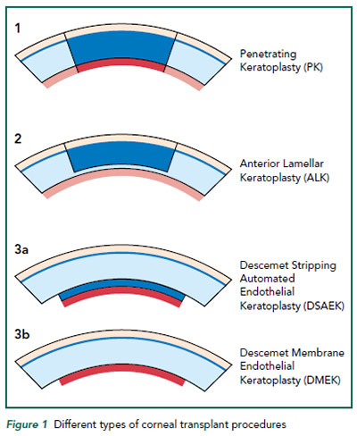 Different types of corneal transplant procedures - Singapore National Eye Centre