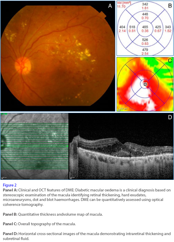 Updates in detection and treatment of diabetic retinopathy in Singapore.