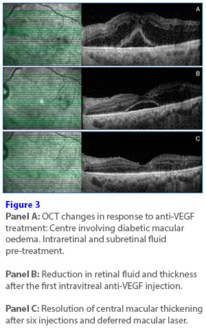 Updates in detection and treatment of diabetic retinopathy in Singapore.