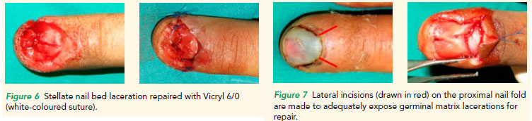 Fingertip injuries | SingHealth