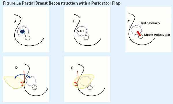 Oncoplastic breast surgery - SingHealth Duke-NUS Breast Centre