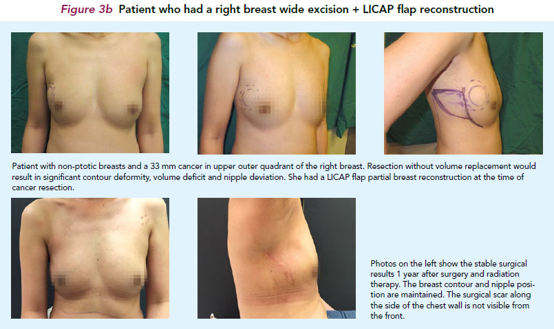 Oncoplastic breast surgery - SingHealth Duke-NUS Breast Centre