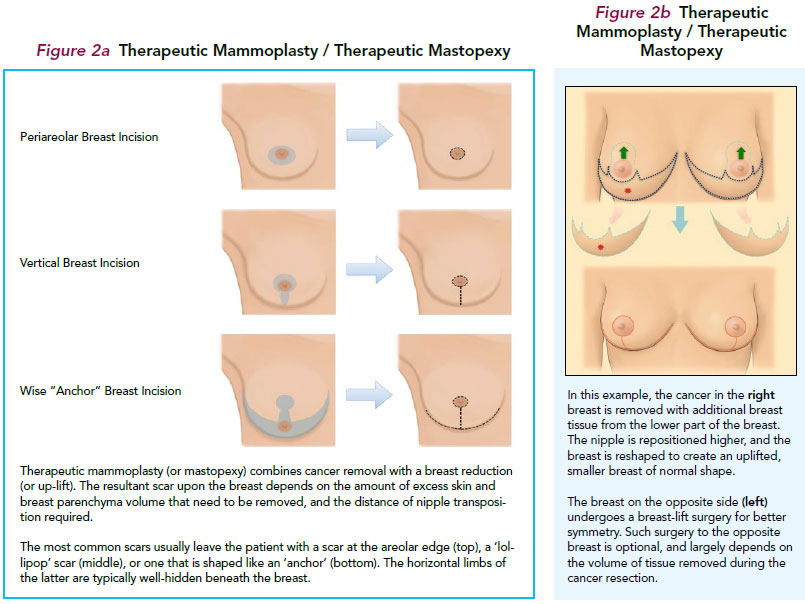 Therapeutic mammoplasty/therapeutic mastopexy - - SingHealth Duke-NUS Breast Centre.
