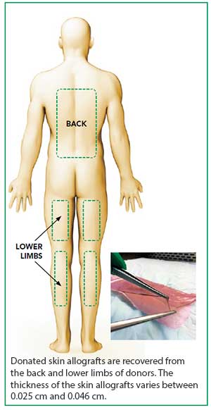 Skin transplant at Singapore General Hospital.