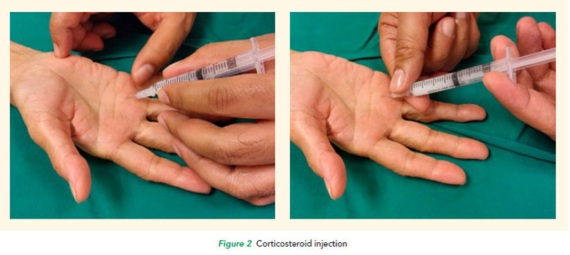 Trigger fingers corticosteroid injection at SGH