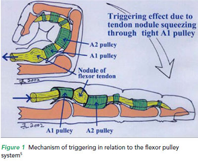 Mechanism of triggering in relation to the flexor pulley system - SGH