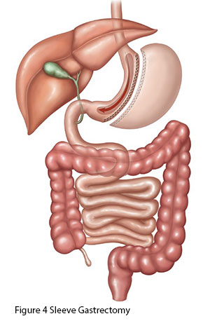 Sleeve Gastrectomy