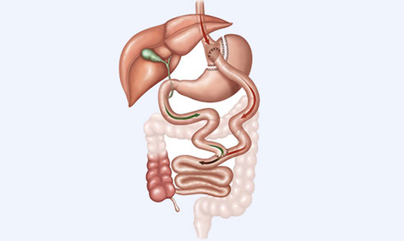 Obesity surgery to manage weight loss by SGH