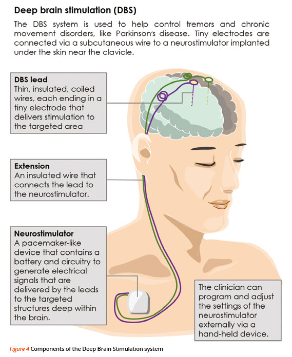 Components of Deep Brain Stimulation System - NNI