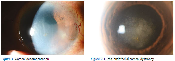 Diseases of the corneal endothelium - Singapore National Eye Centre