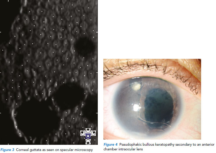 Presentation of endothelial keratoplasty - Singapore National Eye Centre