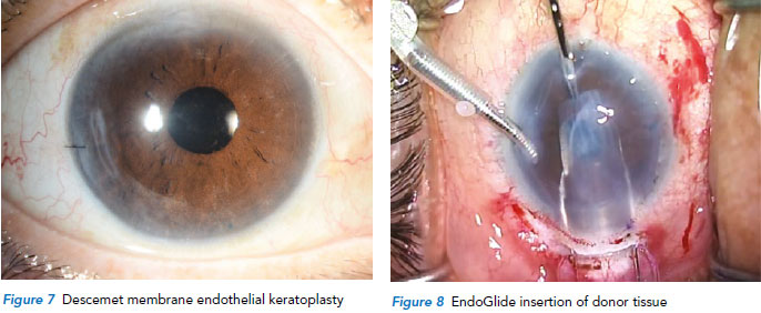 DMEK Endoglide surgery at Singapore National Eye Centre