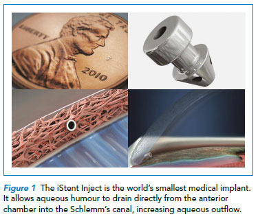 iStent surgical procedure by Singapore National Eye Centre