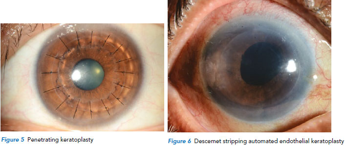 Keratoplasty procedure at Singapore National Eye Centre