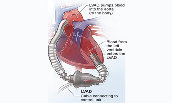 Left Ventricular Assist Device (LVAD) - NHCS