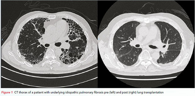 Lung transplant programme at National Heart Centre Singapore