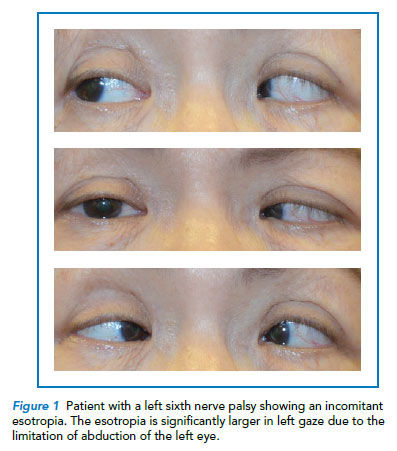 Patient with incomitant esotropia - Singapore National Eye Centre