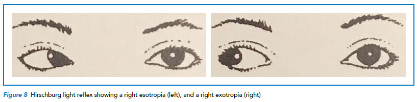 Hirschburg light reflex to diagnose strabismus or squint - Singapore National Eye Centre