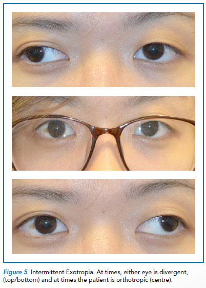 Common Strabismus In Children Singhealth