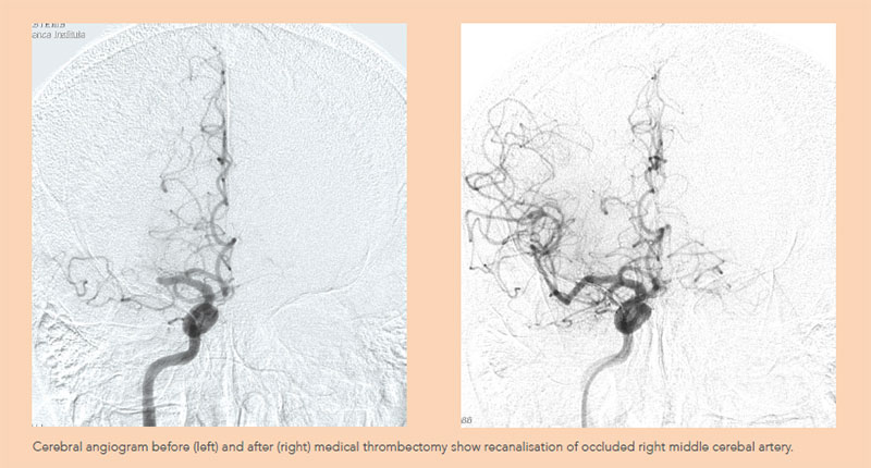 Cerebral angiogram before and after medical thrombectomy - National Neuroscience Institute