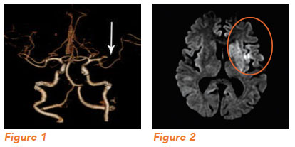 Blood clot in the brain as viewed in CT Scan and MRI. Nerosciense Institute