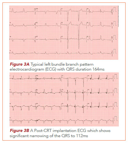 Cardiac Dyssynchrony - National Heart Centre Singapore